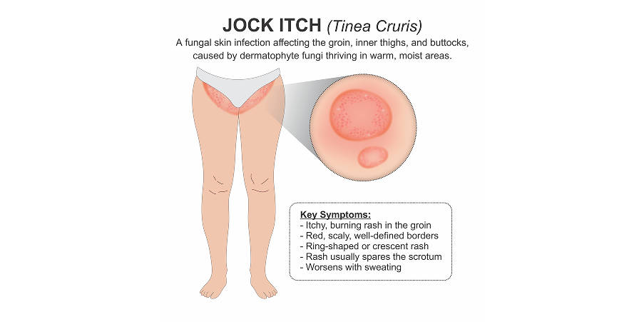Tinea Corporis, Cruris and Pedis_Initial Assesment 2